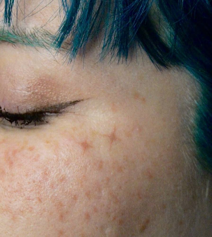 Star freckles cosmetic tattoo located on the face.