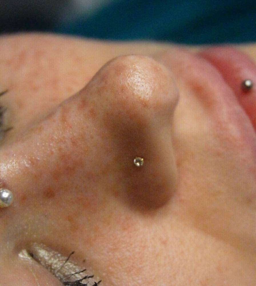 Freckles cosmetic tattoo located on the face.