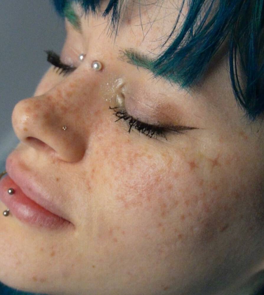 Freckles cosmetic tattoo located on the face.
