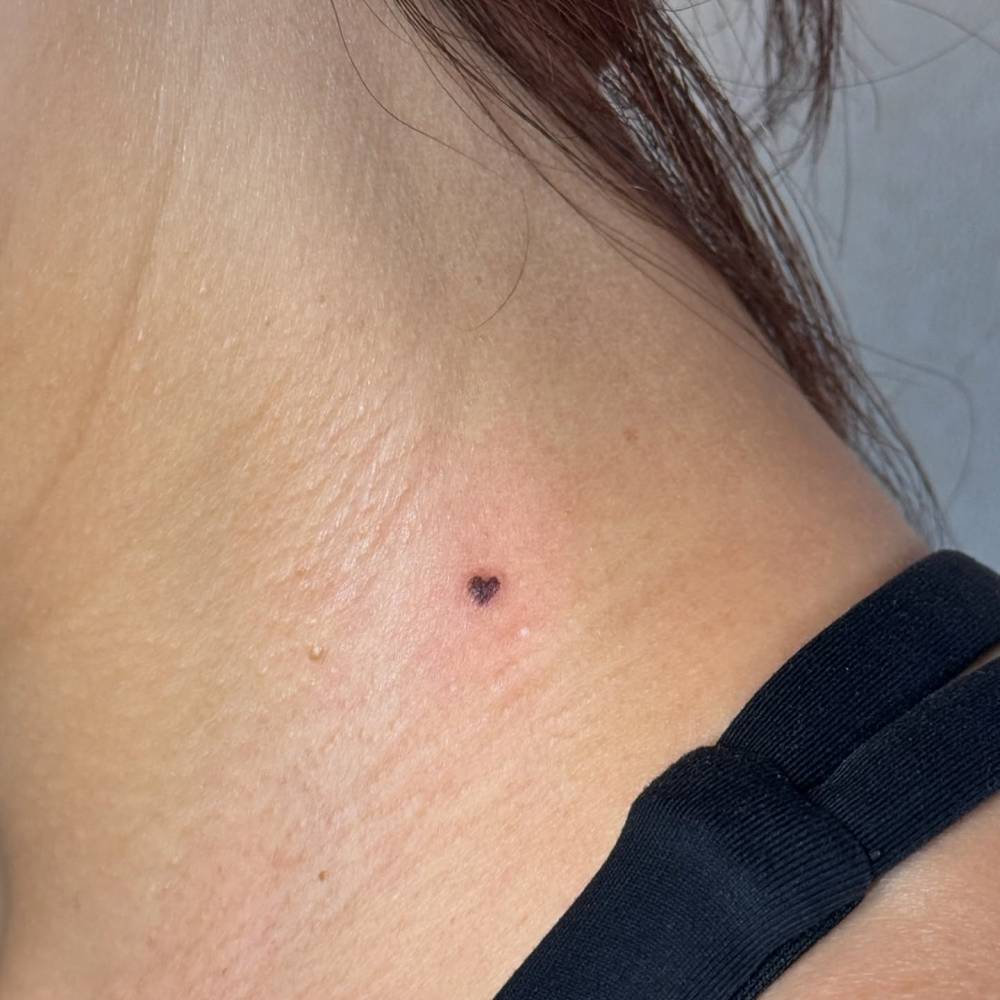 Minimalistic heart tattoo covering a mole located on the neck.